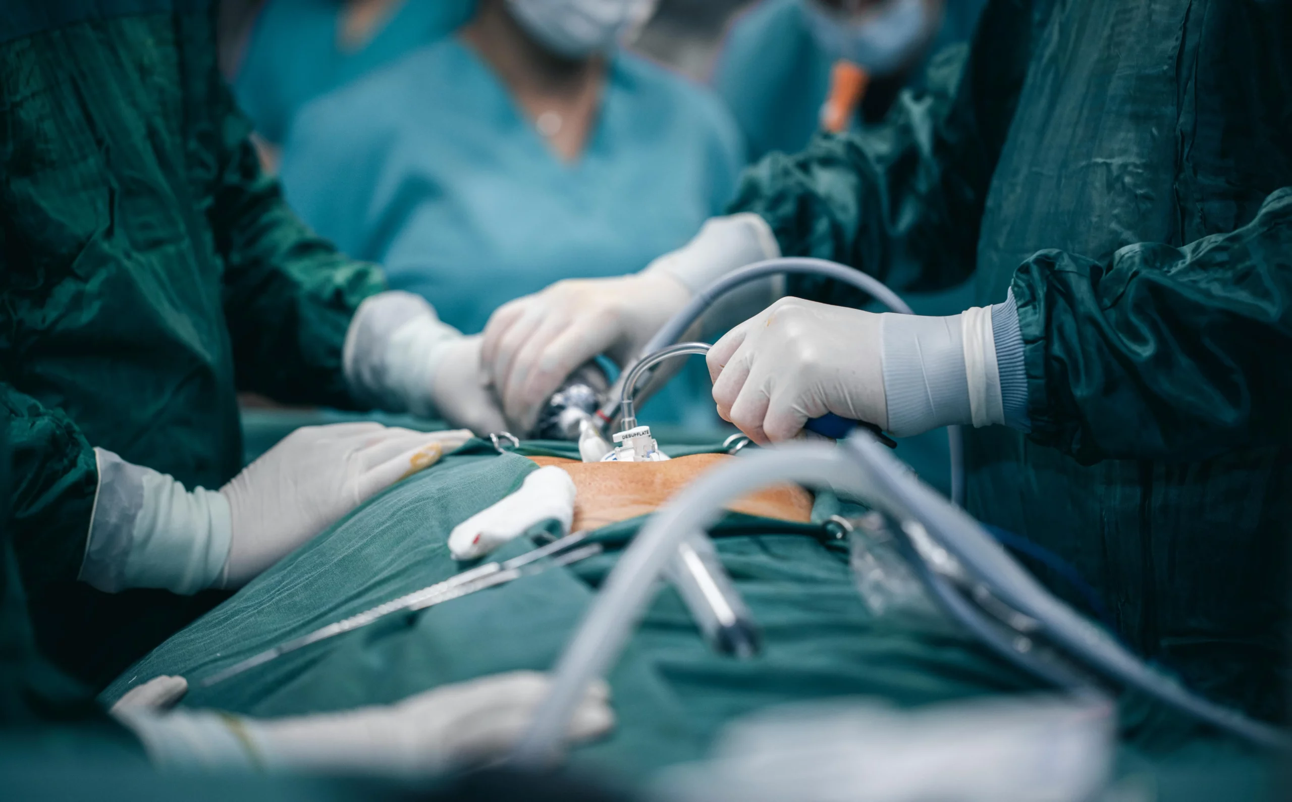ufe vs myomectomy